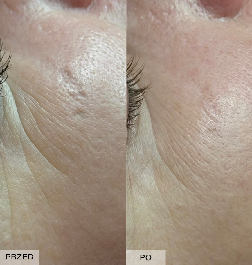 usuwanie blizn efekty